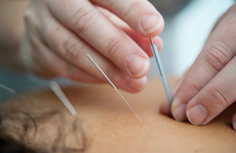 Close-up of a practitioner inserting thin acupuncture needles into a person's skin during an acupuncture treatment.